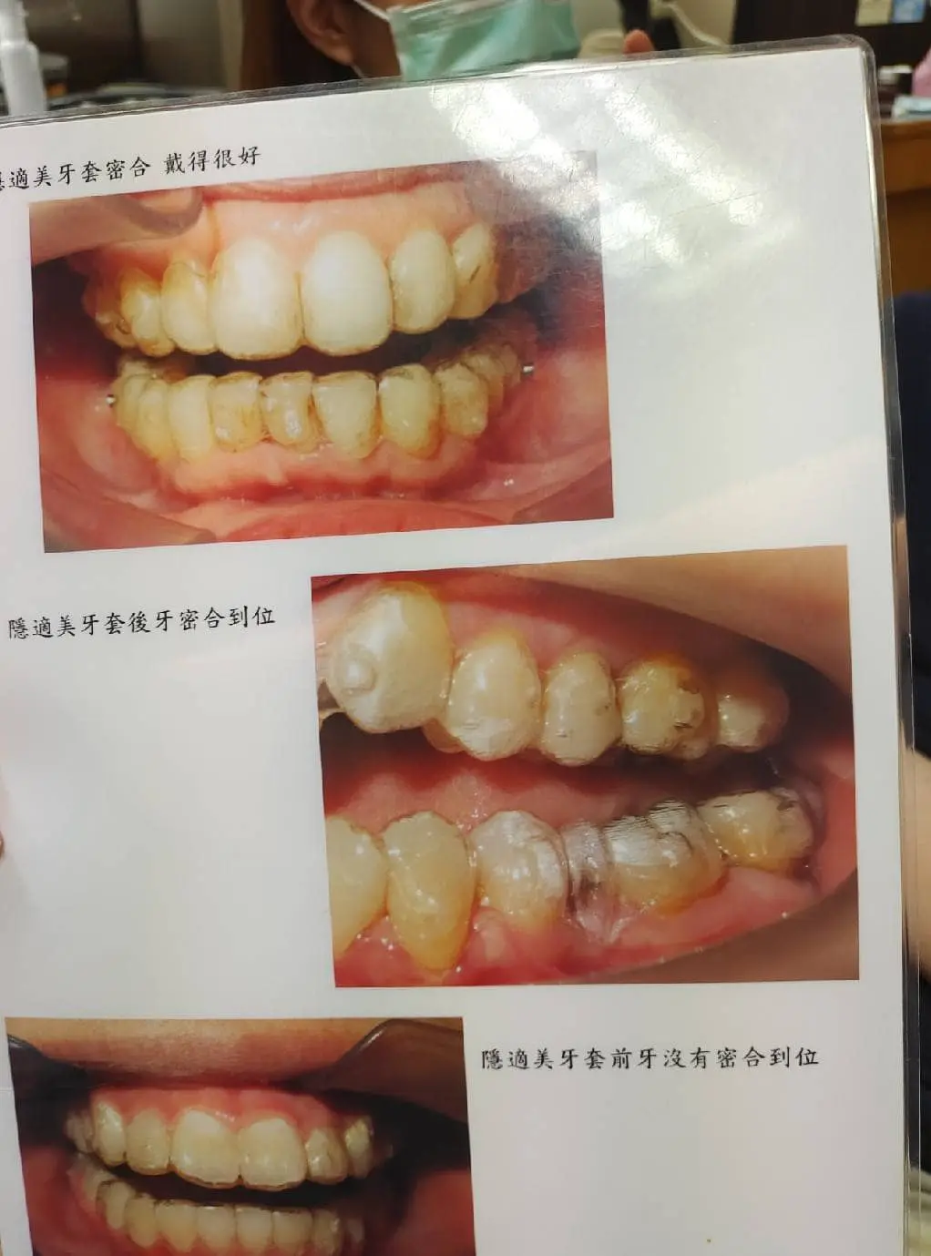上誠牙醫|隱適美|張先生牙齒矯正計畫分享 11 隱適美配戴教學