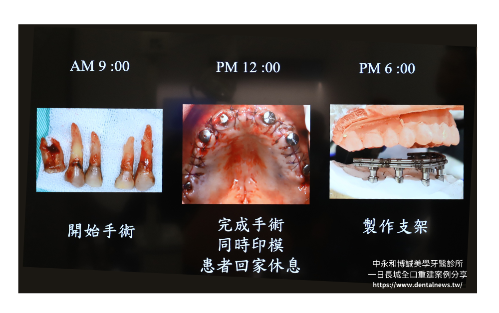 【新北植牙推薦】中永和博誠美學牙醫診所一日長城全口重建案例分享|一日植牙就找何家銘院長 18 博誠美學一日長城發表會