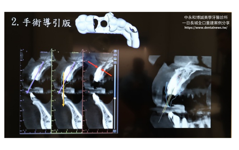 【新北植牙推薦】中永和博誠美學牙醫診所一日長城全口重建案例分享|一日植牙就找何家銘院長 16 博誠美學一日長城發表會