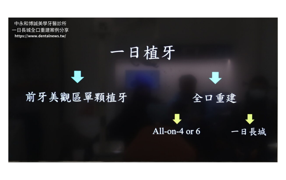 【新北植牙推薦】中永和博誠美學牙醫診所一日長城全口重建案例分享|一日植牙就找何家銘院長 11 博誠美學一日長城發表會