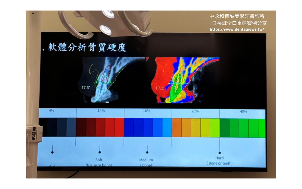 【新北植牙推薦】中永和博誠美學牙醫診所一日長城全口重建案例分享|一日植牙就找何家銘院長 15 博誠美學一日長城發表會