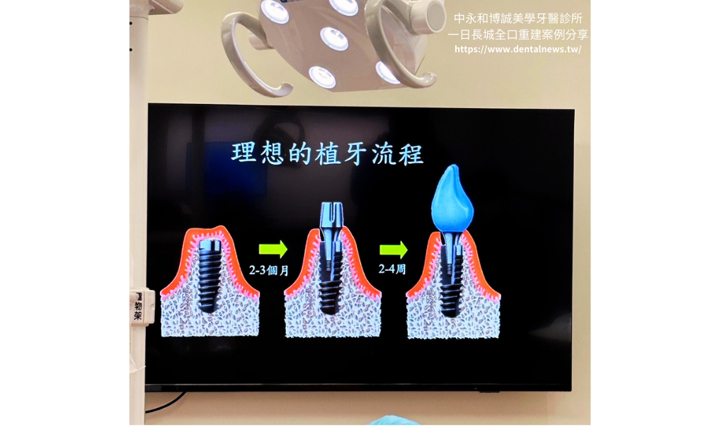 【新北植牙推薦】中永和博誠美學牙醫診所一日長城全口重建案例分享|一日植牙就找何家銘院長 12 博誠美學一日長城發表會