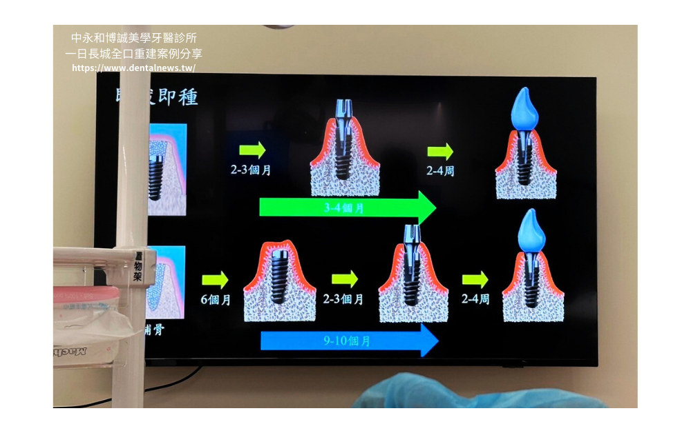 【新北植牙推薦】中永和博誠美學牙醫診所一日長城全口重建案例分享|一日植牙就找何家銘院長 13 博誠美學一日長城發表會