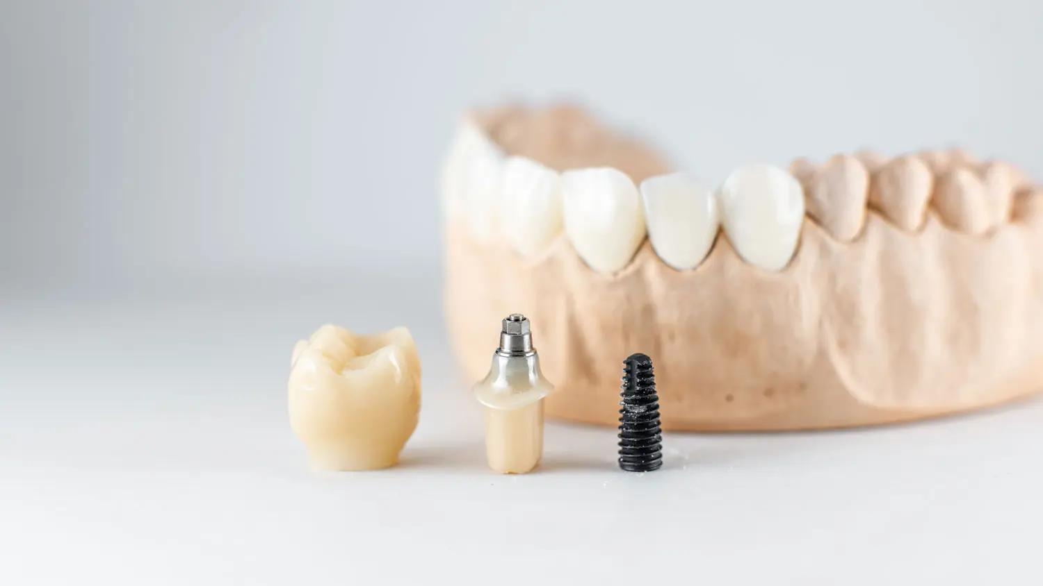 implant implant