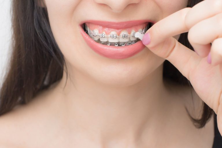 牙齒矯正後遺症有哪些?該如何矯正牙齒黑三角? 1 applying orthodontic wax on the dental braces bra 2021 10 13 01 09 07 utc