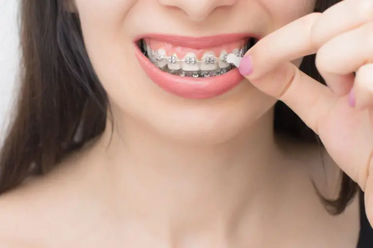 牙齒矯正後遺症有哪些?該如何矯正牙齒黑三角? 3 applying orthodontic wax on the dental braces bra 2021 10 13 01 09 07 utc