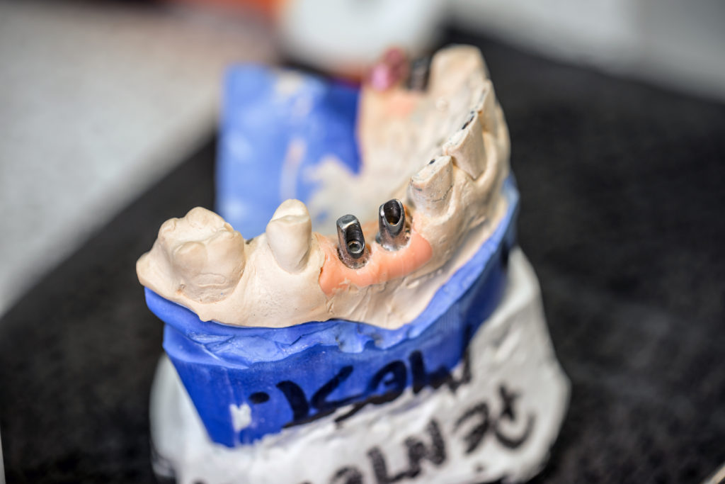 dental implants 2021 08 26 17 52 15 utc scaled e1660702183848