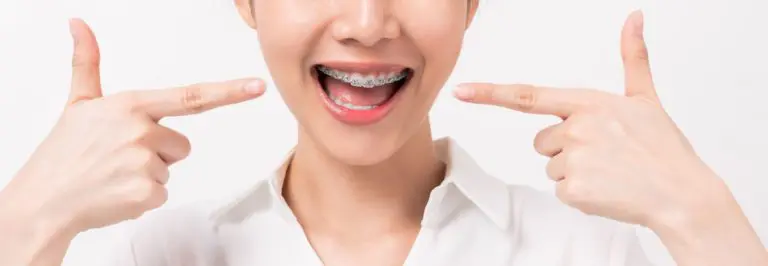 牙齒矯正臉型會有影響嗎?醫師這樣說 10 face of a young smiling asian woman with braces on 2021 09 01 18 14 37 utc 1