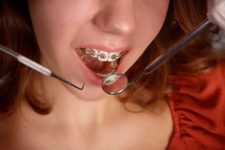 矯正拔牙不是每個人都需要,早點矯正可能不用拔牙 12 girl teeth braces and dentist tools 2022 08 01 03 07 39 utc