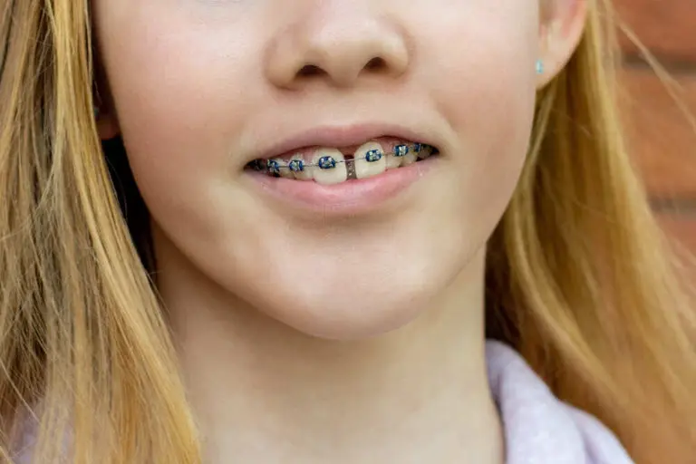 二次矯正的原因有哪些?要怎麼避免? 6 teenage girl wearing metal braces orthodontic den 2021 12 17 18 54 38 utc