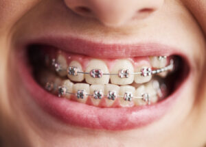 shot of child s teeth with braces 2023 11 27 04 54 05 utc
