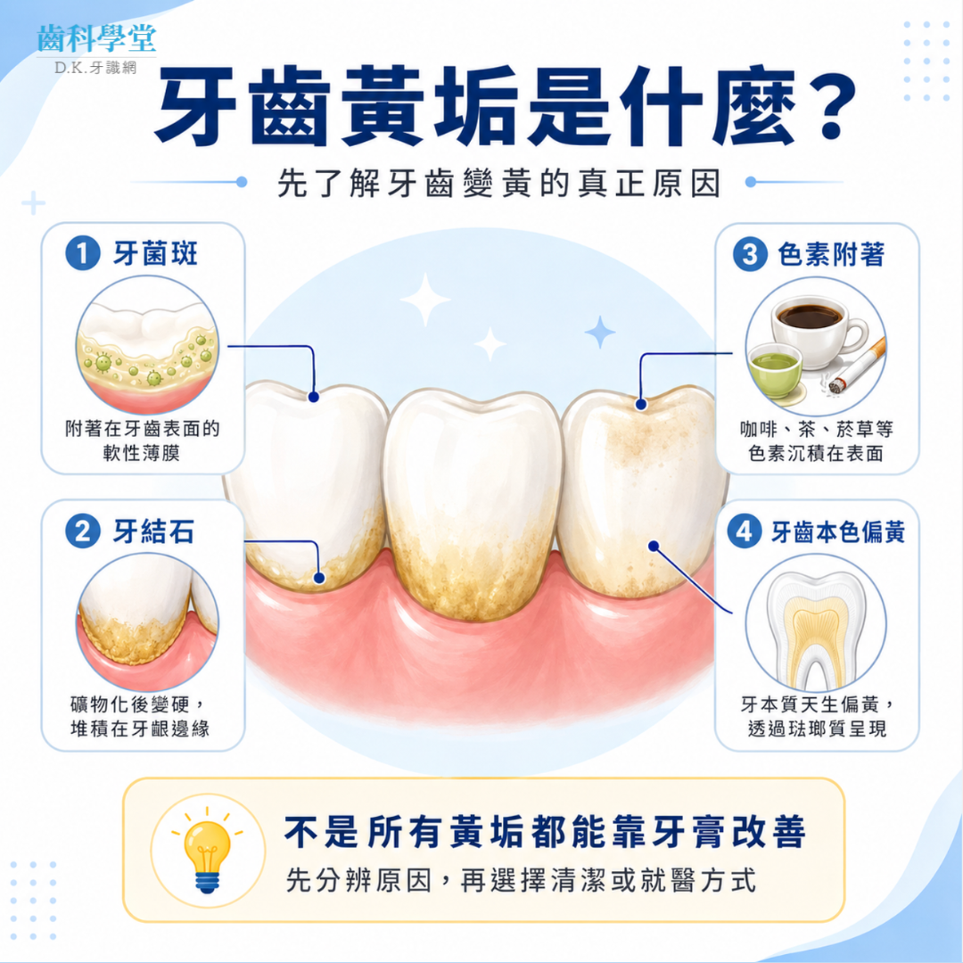 牙齒黃垢是什麼？