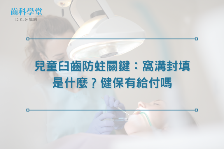 兒童臼齒防蛀關鍵：窩溝封填是什麼？健保有給付嗎