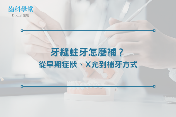 牙縫蛀牙怎麼補？從早期症狀、X光到補牙方式