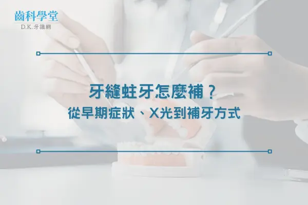 牙縫蛀牙怎麼補？從早期症狀、X光到補牙方式