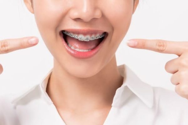face of a young smiling asian woman with braces on 2021 09 01 18 14 37 utc 1
