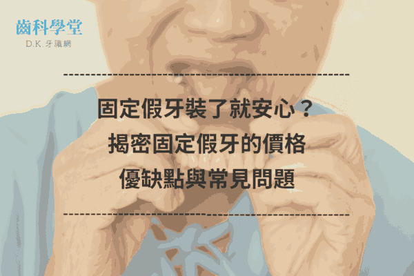 固定假牙裝了就安心？揭密固定假牙的價格、優缺點與常見問題