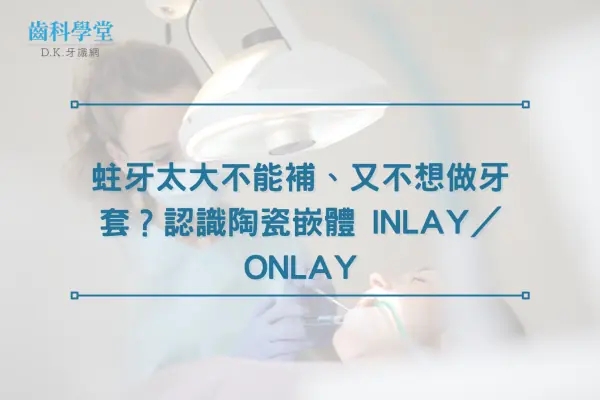 蛀牙太大不能補、又不想做牙套？認識陶瓷嵌體 Inlay／Onlay